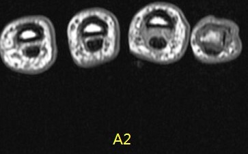 Figure 6 for case A2 pulley rupture finger (RID2437)